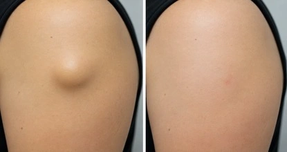 Lipoma treatment